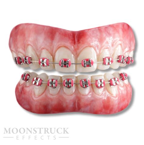 how much are fake braces